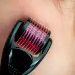 2mm titanium derma roller for acne scars and hair regrowth - obeepo.in